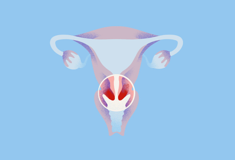 cervical cancer type illustration