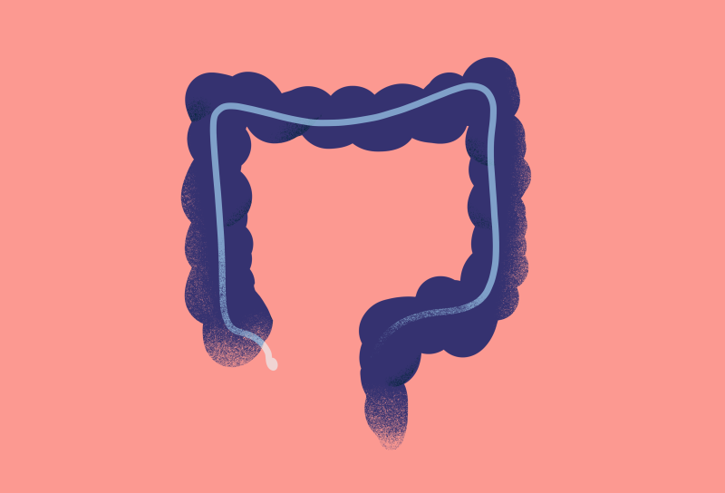 colon cancer illustration