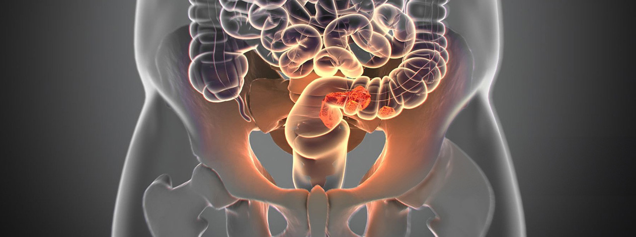rectal-cancer-caner-type-organs-inside-3d-illustration